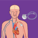 Implantable Cardiac Defibrillator (ICD)